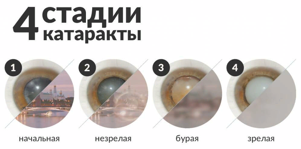 Стадии катаракты 