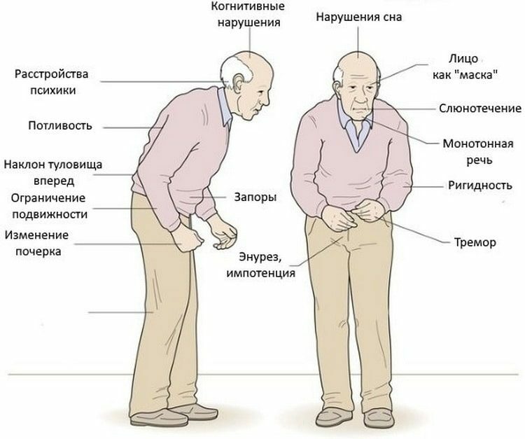 Симптомы болезни Паркинсона 